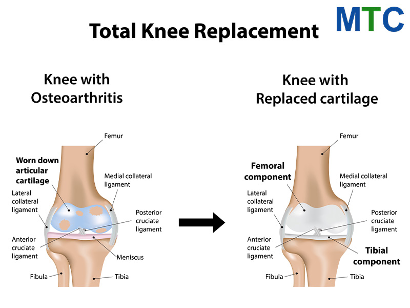 Knee replacement in Lithuania