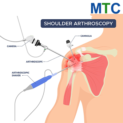 Shoulder Arthroscopy in Lithuania