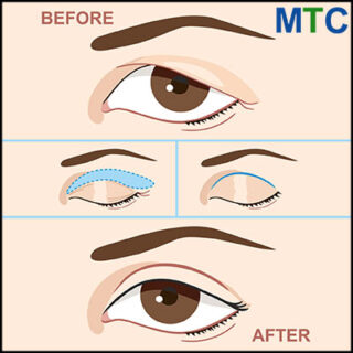 Blepharoplasty in Tijuana