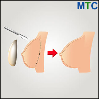 Breast augmentation in Tijuana