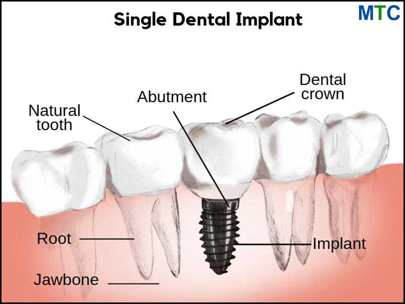 Dental Implant