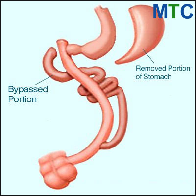 Duodenal Switch