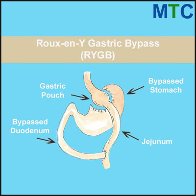 Gastric Bypass