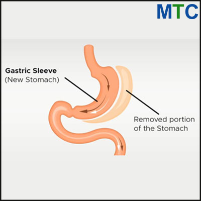 Gastric Sleeve