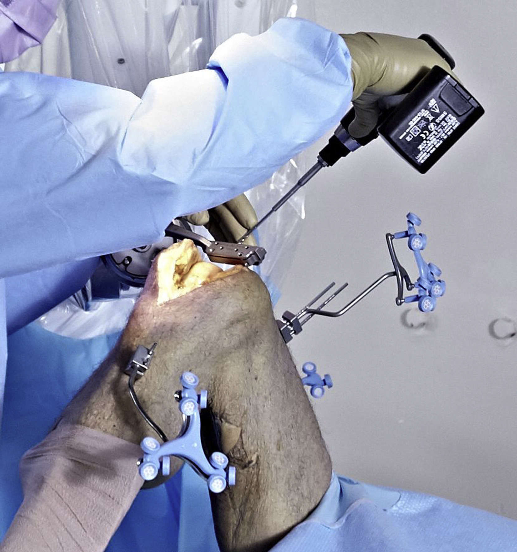 Robotic Knee Replacement Surgery