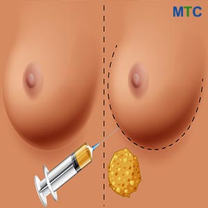 Breast Lift