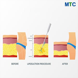 Liposuction