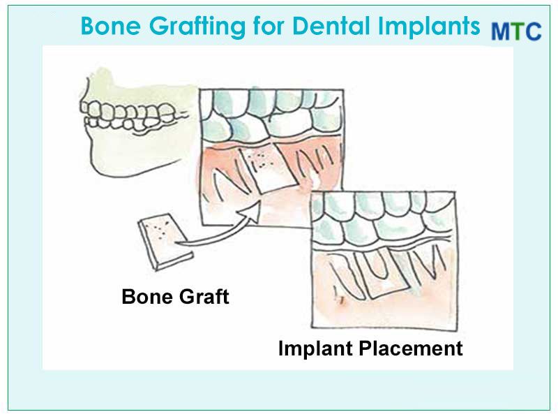 Bone Grafting for Dental Implants