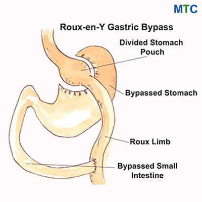 Roux-en-Y Bariatric Surgery