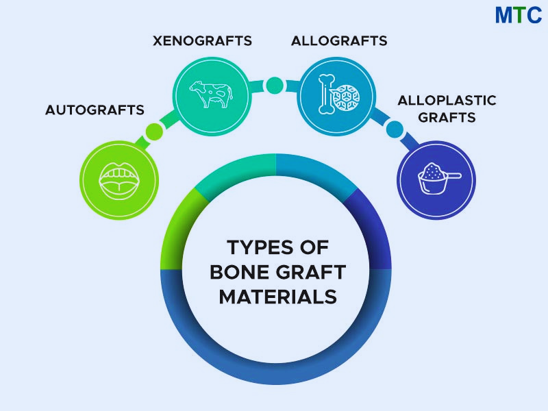 Types of Bone Grafts