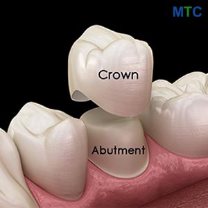 Dental Crown