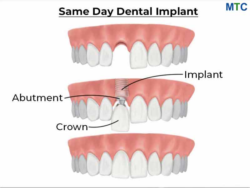 Same-Day-Implants.jpg