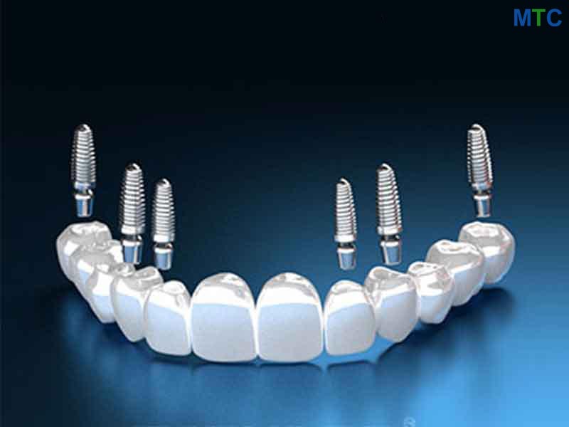 3 on 6 Implant-Supported Dentures