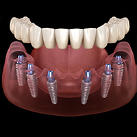 All-on-6 Implants