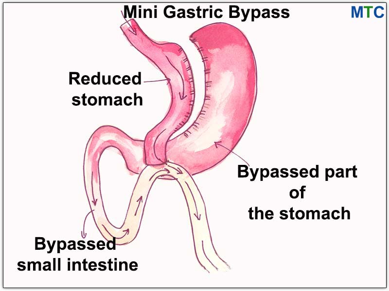 Mini Gastric Bypass