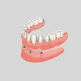 Snap-on Dentures