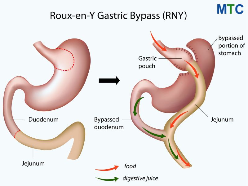 Gastric Bypass Procedure