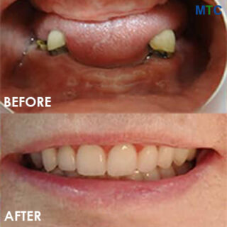 Mini dental implants in Cancun - Before & After