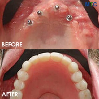 Mini dental implants in Cancun - Before & After