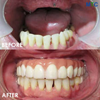 Mini dental implants in Cancun - Before & After