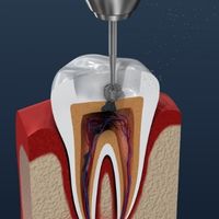 Root Canal Treatment