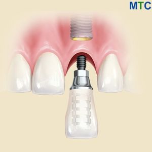 Dental implants in Phuket