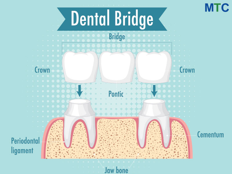 Dental Bridge in Costa Rica