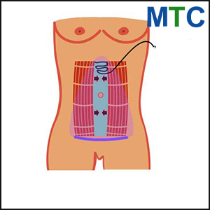 Mini Abdominoplasty