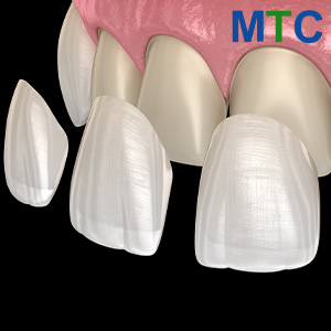 Dental Veneers