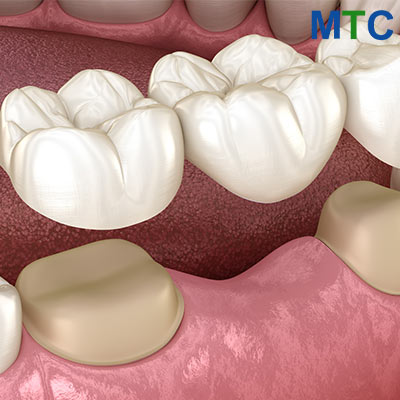 Dental Bridge