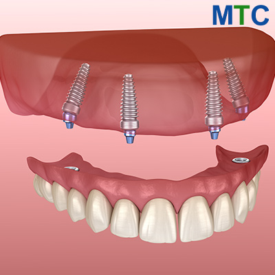 All-on-4 Implants Croatia