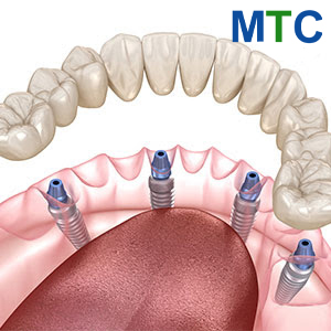 All on 4 dental implants