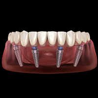 All on 4 Dental Implants