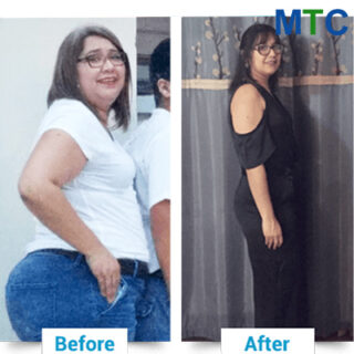 Before & After Pics | Gastric Sleeve in Nuevo Laredo