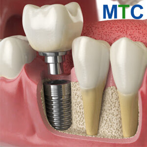 Same Day Dental Implant