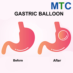 Gastric Balloon in Mexico