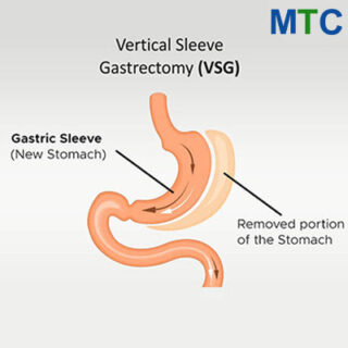 Procedure of Gastric Sleeve Surgery