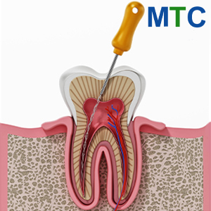 Root Canal Treatment