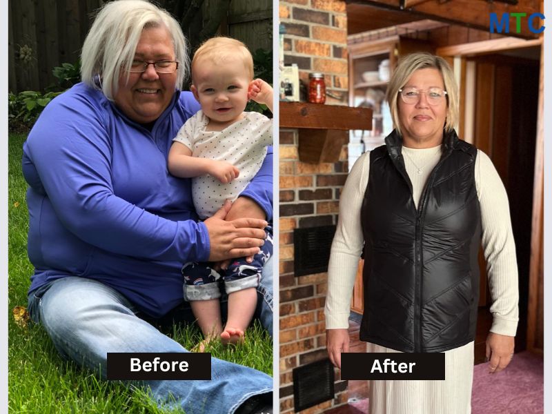 Before & After: Gastric Sleeve in Mexico