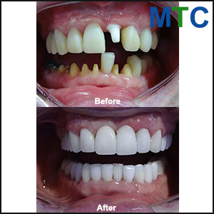 Before and after dental implants