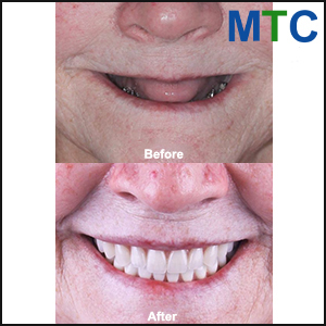 Before and after dental implants