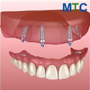 Dental Implants Turkey