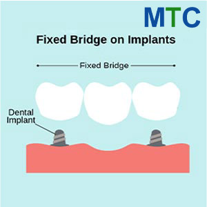 Fixed Dental Bridge