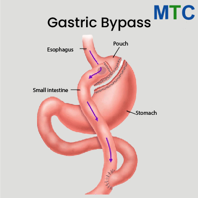 Gastric Bypass