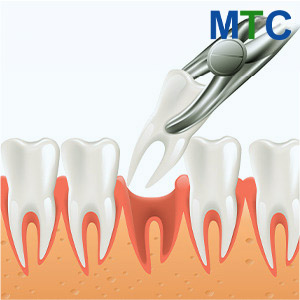 Teeth Extraction Turkey