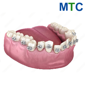 Dental Braces Turkey