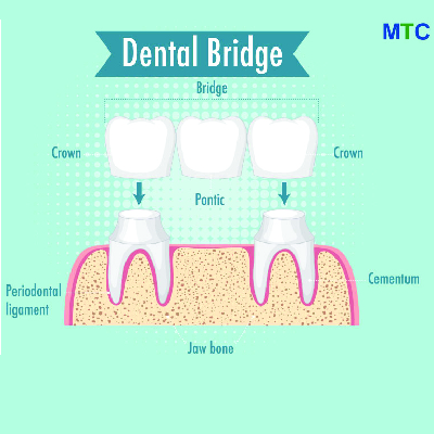 Dental Bridge in Costa Rica