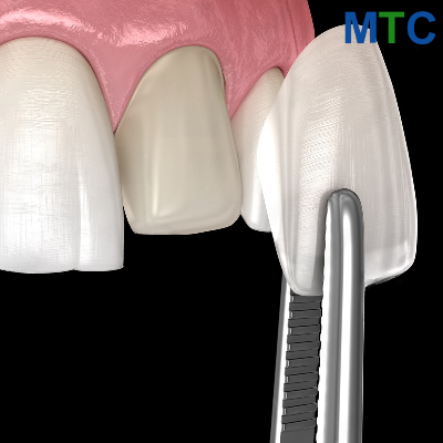 Zirconia veneers in Cancun