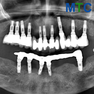 Implant X-ray