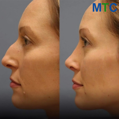 Before & After: Rhinoplasty in Turkey